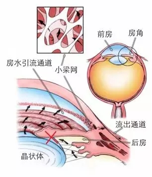 當(dāng)青光眼遇上白內(nèi)障，這場防盲保衛(wèi)戰(zhàn)該怎么打？