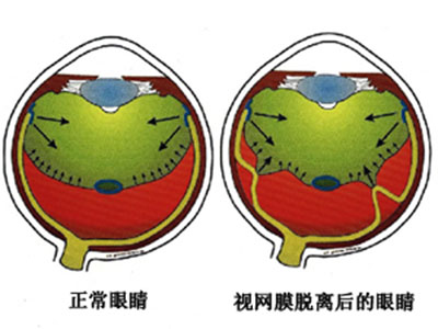 視疲勞可導致視網膜脫落？！