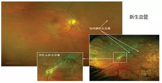 非接觸、免散瞳、超廣角眼底檢查不是夢(mèng)！