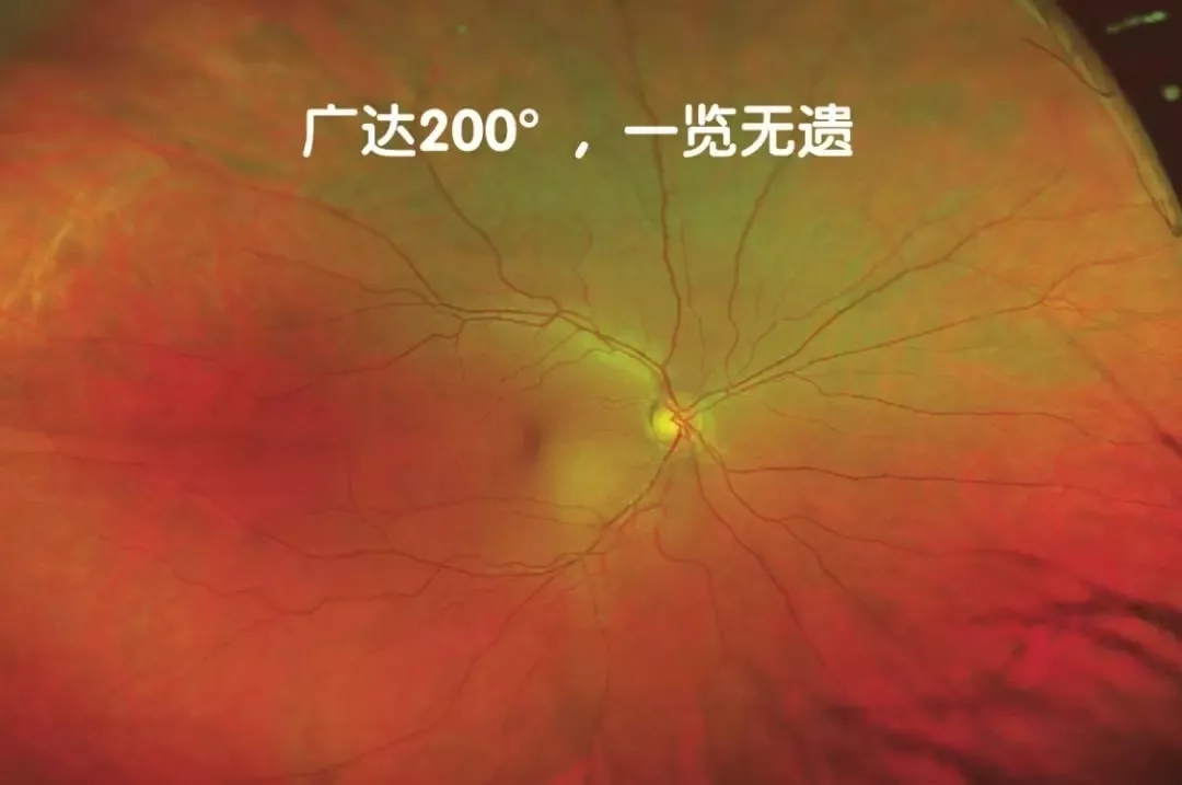 非接觸、免散瞳、超廣角眼底檢查不是夢(mèng)！
